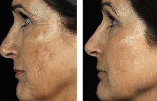 Avant et après le rajeunissement fractionné du visage