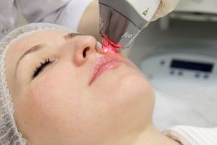 Processus de rajeunissement de la peau du visage avec un laser fractionné