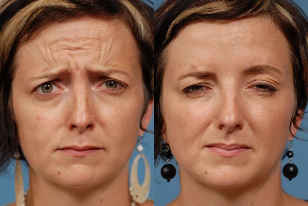 avant et après l'utilisation du masseur pour le rajeunissement ltza photo 2