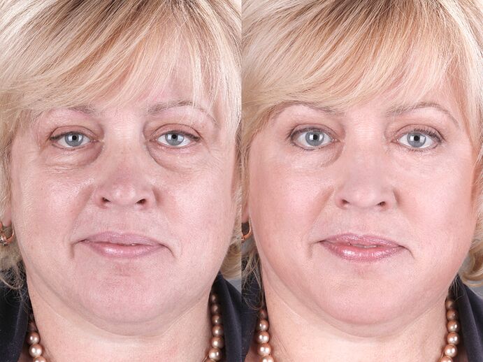 avant et après l'utilisation du masseur pour le rajeunissement ltza photo 3