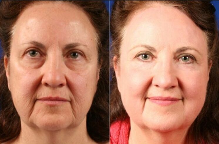 avant et après l'utilisation du masseur pour le rajeunissement ltza photo 6