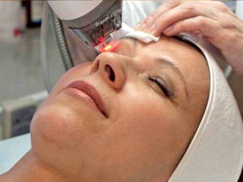 Rajeunissement au laser de la peau autour des yeux