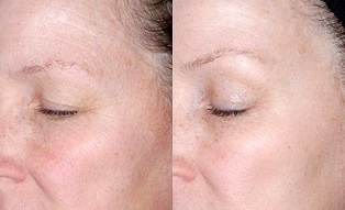 Rajeunissement de la peau autour des yeux avant et après les photos