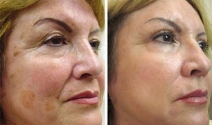 rajeunissement fractionné de la peau avant et après les photos