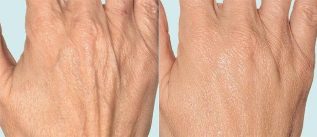 Peau des mains avant et après la thérapie fractionnée