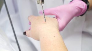 Rajeunissement au laser de la peau des mains